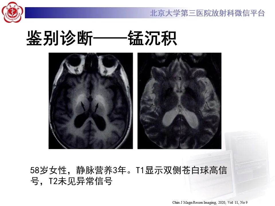 影像PPT - 【PPT】非酮症高血糖性偏侧舞蹈症-33