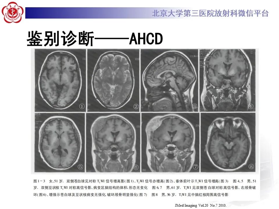 影像PPT - 【PPT】非酮症高血糖性偏侧舞蹈症-36