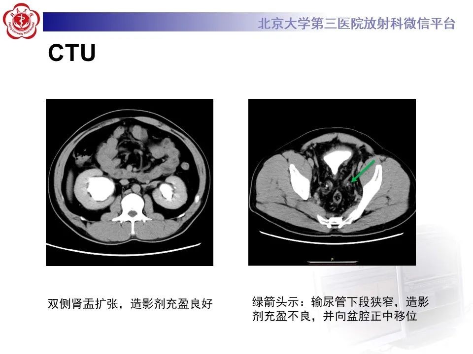 影像PPT - 【PPT】盆腔脂肪增多症-3