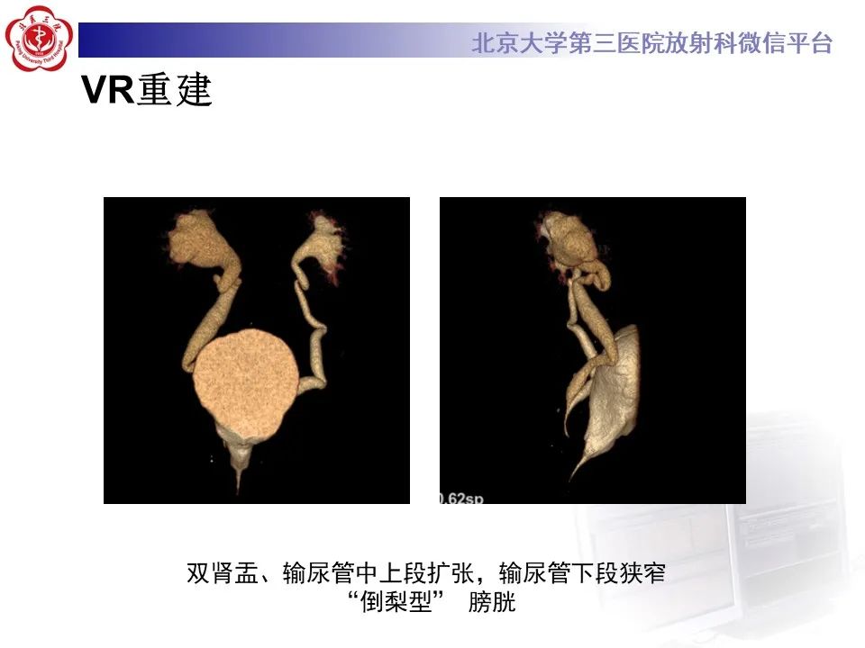 影像PPT - 【PPT】盆腔脂肪增多症-5