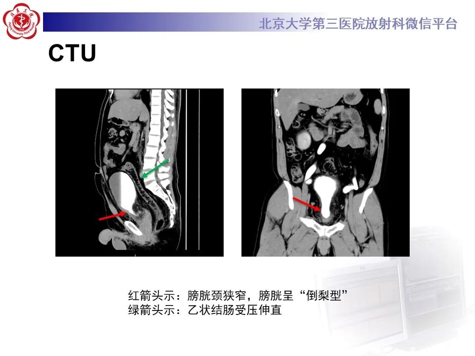 影像PPT - 【PPT】盆腔脂肪增多症-4