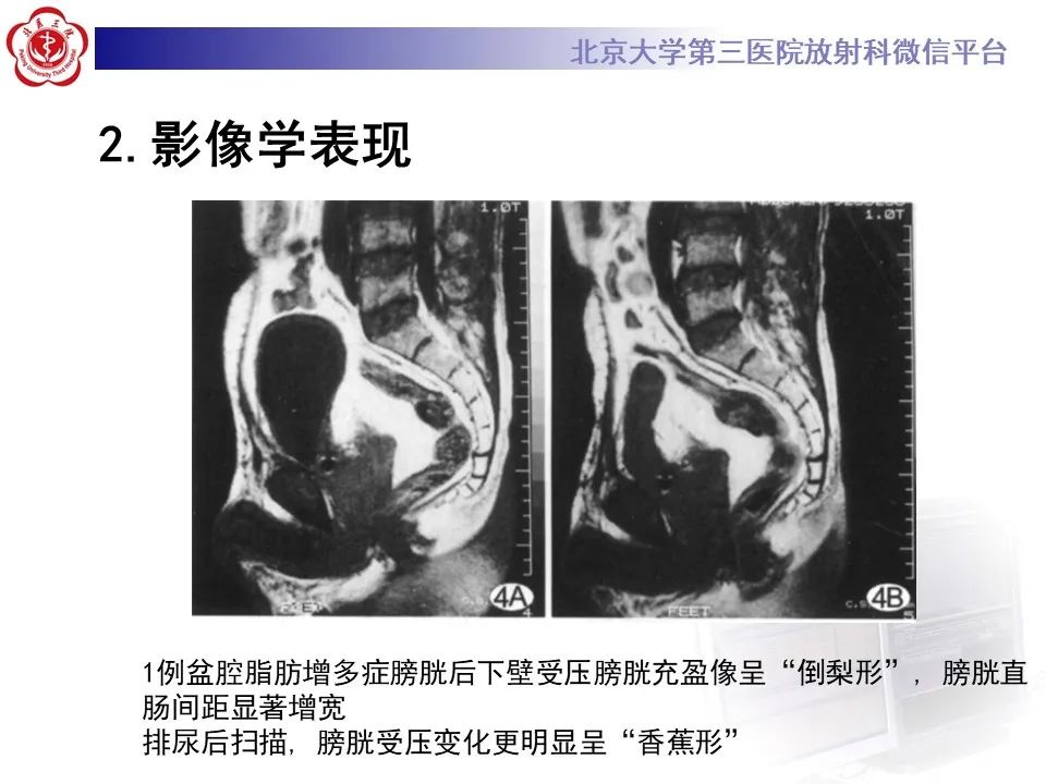 影像PPT - 【PPT】盆腔脂肪增多症-14
