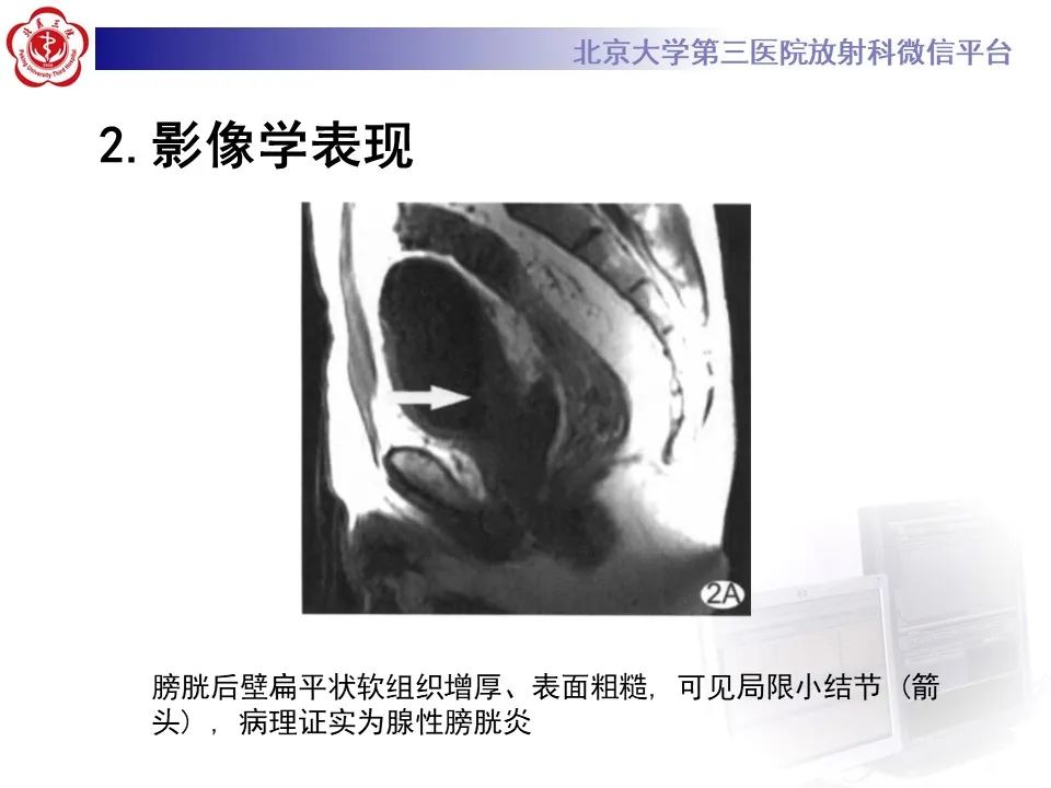 影像PPT - 【PPT】盆腔脂肪增多症-15