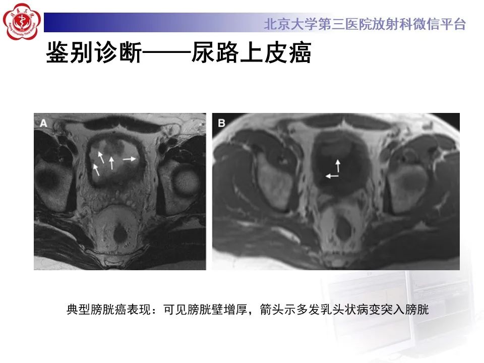 影像PPT - 【PPT】盆腔脂肪增多症-18