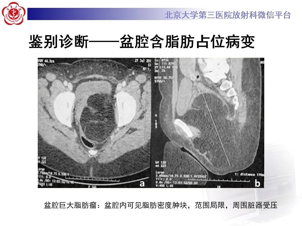 影像PPT - 【PPT】盆腔脂肪增多症-20