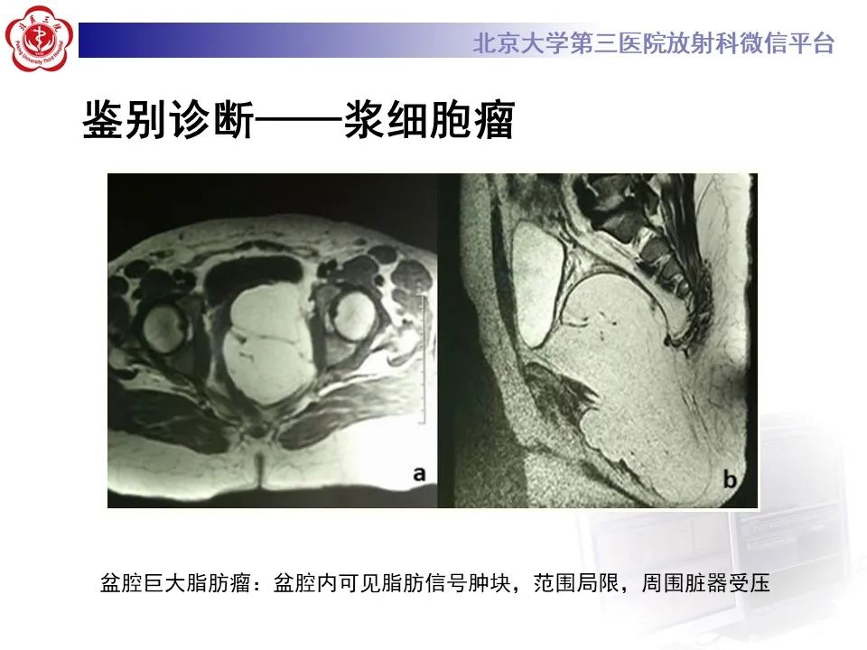 影像PPT - 【PPT】盆腔脂肪增多症-21