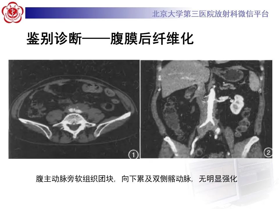 影像PPT - 【PPT】盆腔脂肪增多症-23