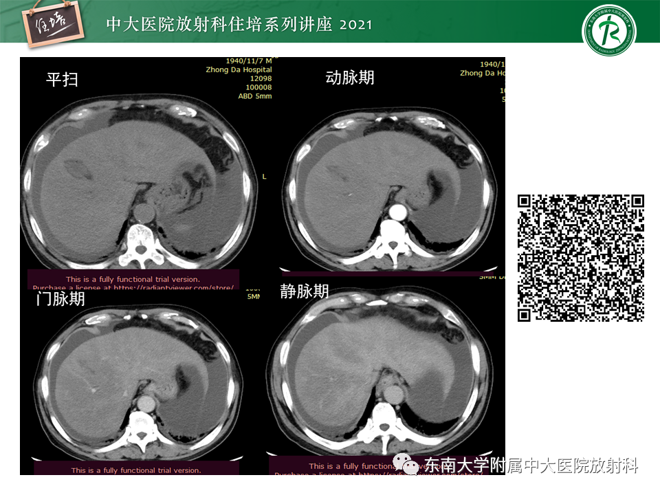 影像PPT - 【PPT】肝窦阻塞综合征-3