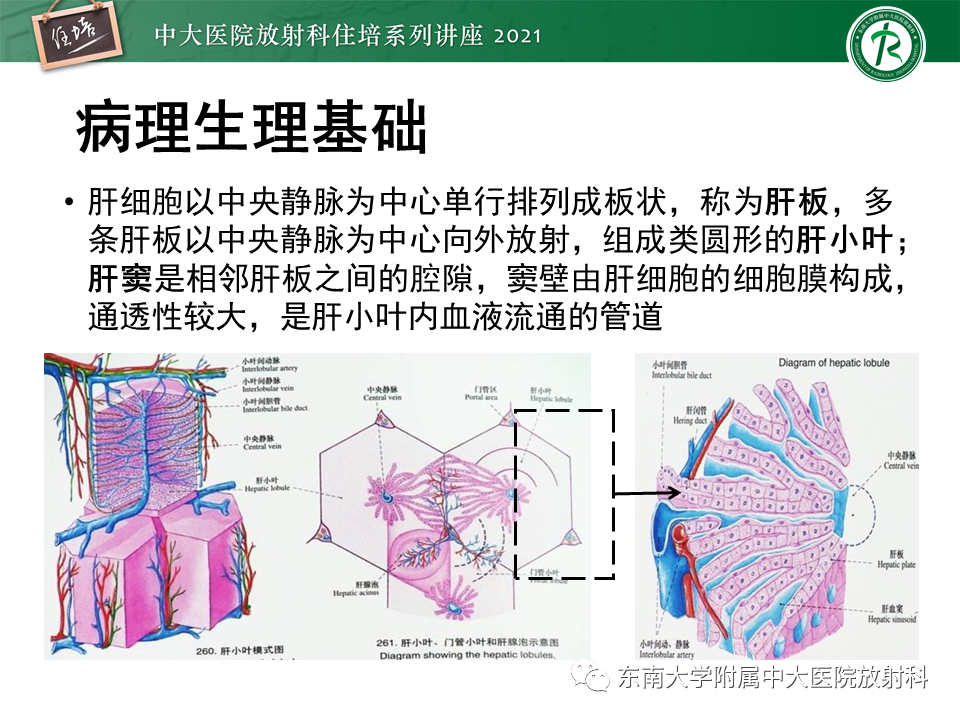 影像PPT - 【PPT】肝窦阻塞综合征-11