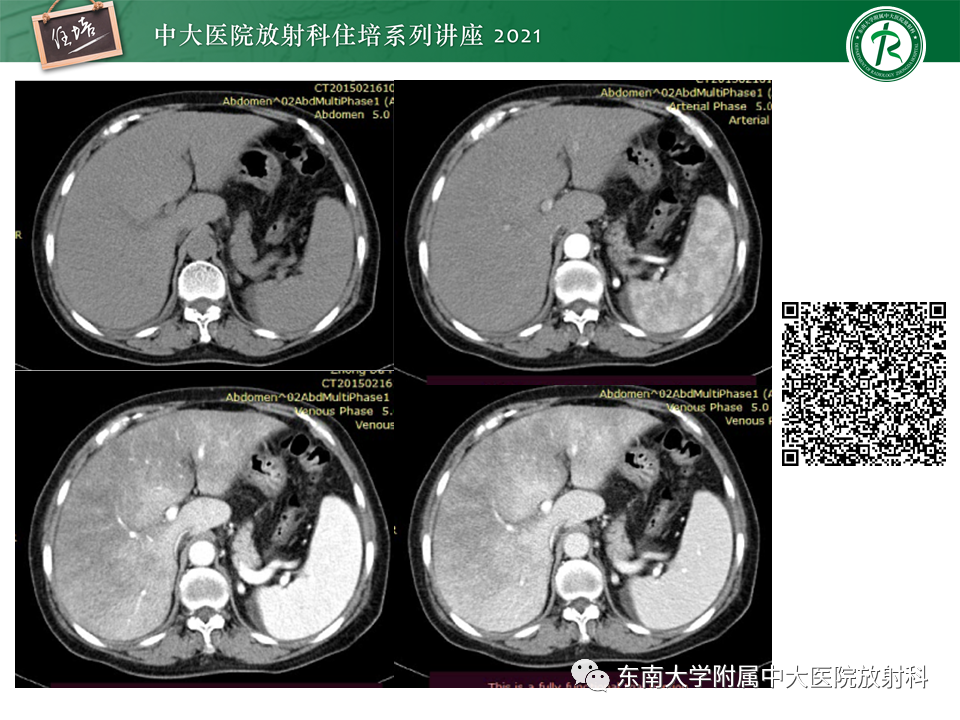 影像PPT - 【PPT】肝窦阻塞综合征-19