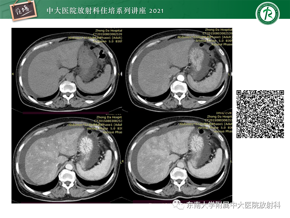 影像PPT - 【PPT】肝窦阻塞综合征-21