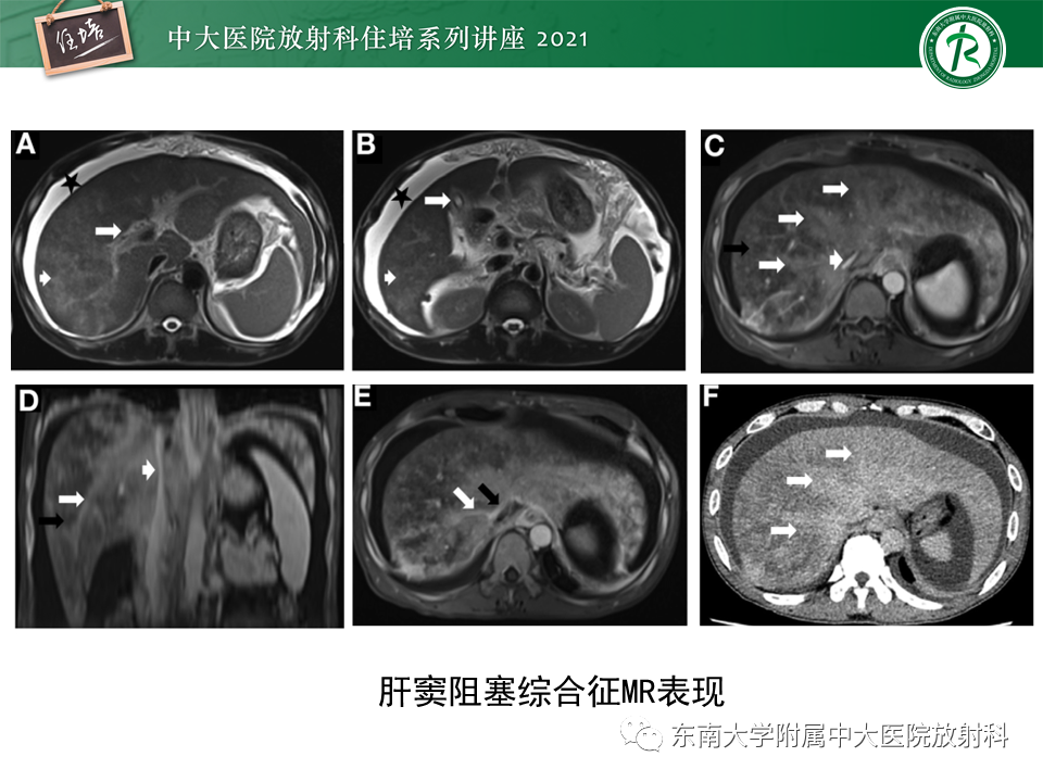 影像PPT - 【PPT】肝窦阻塞综合征-23