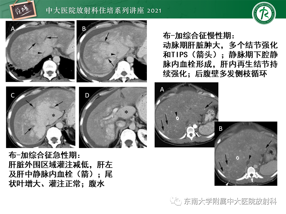 影像PPT - 【PPT】肝窦阻塞综合征-29