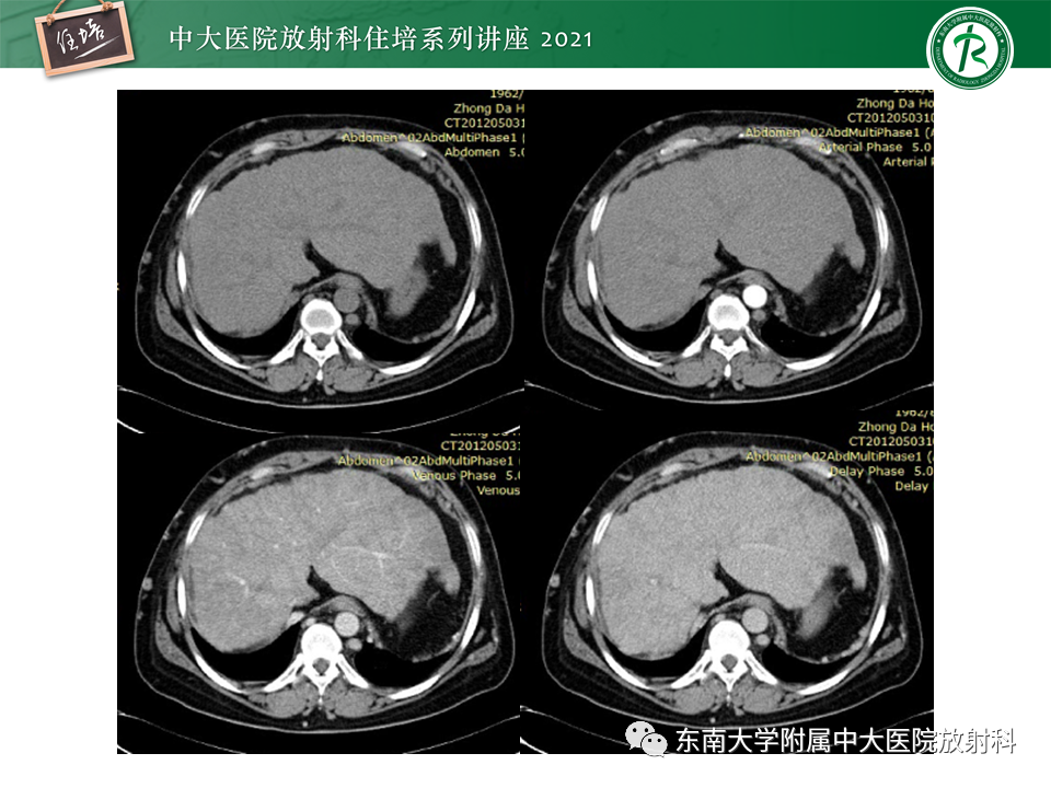 影像PPT - 【PPT】肝窦阻塞综合征-28