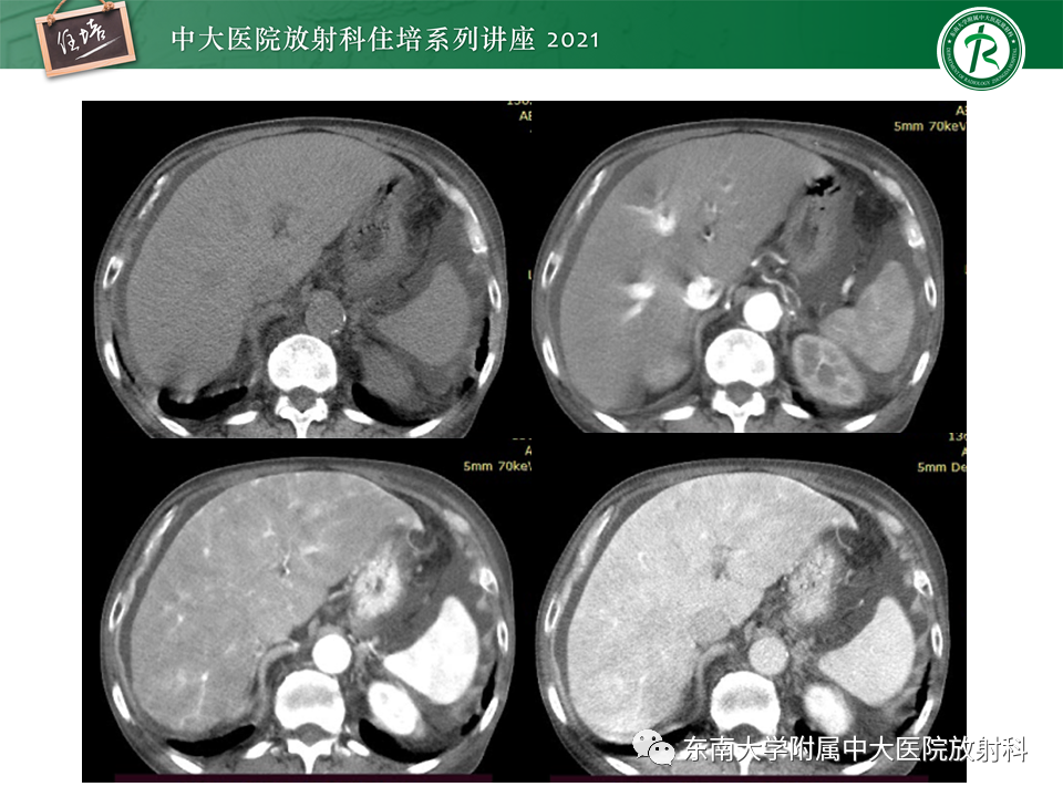 影像PPT - 【PPT】肝窦阻塞综合征-32