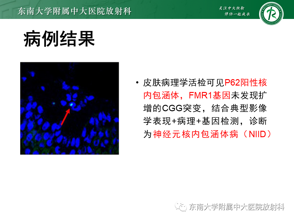影像PPT - 【PPT】神经元核内包涵体病-2
