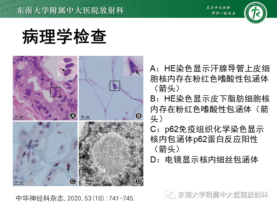影像PPT - 【PPT】神经元核内包涵体病-8