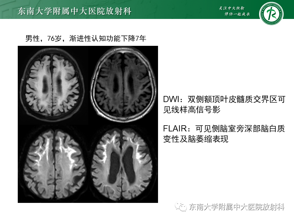 影像PPT - 【PPT】神经元核内包涵体病-13