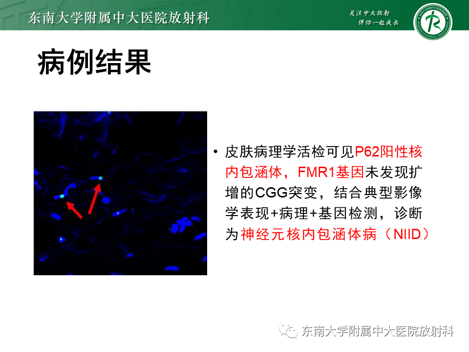 影像PPT - 【PPT】神经元核内包涵体病-14