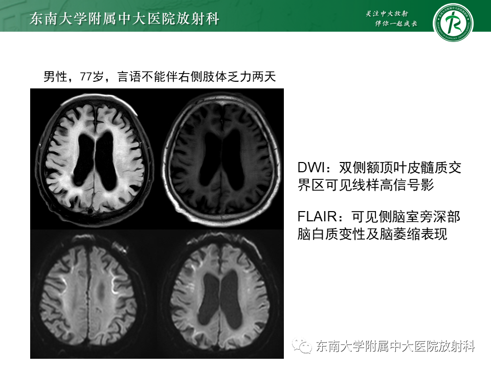 影像PPT - 【PPT】神经元核内包涵体病-15