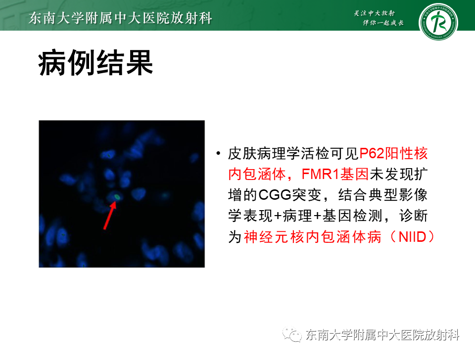 影像PPT - 【PPT】神经元核内包涵体病-16