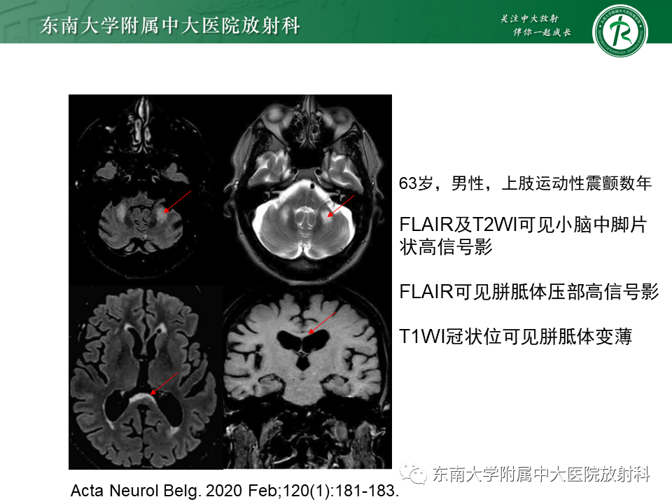 影像PPT - 【PPT】神经元核内包涵体病-18