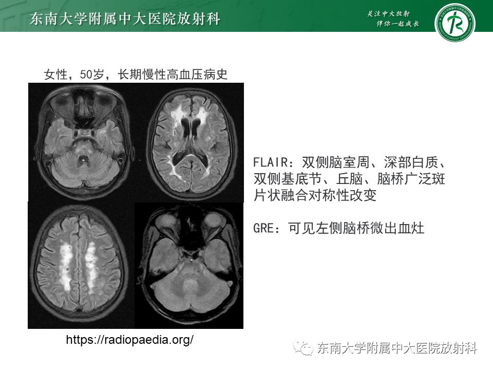 影像PPT - 【PPT】神经元核内包涵体病-20