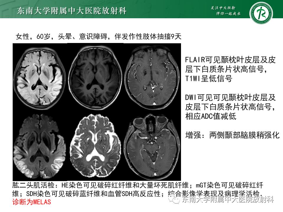 影像PPT - 【PPT】神经元核内包涵体病-23