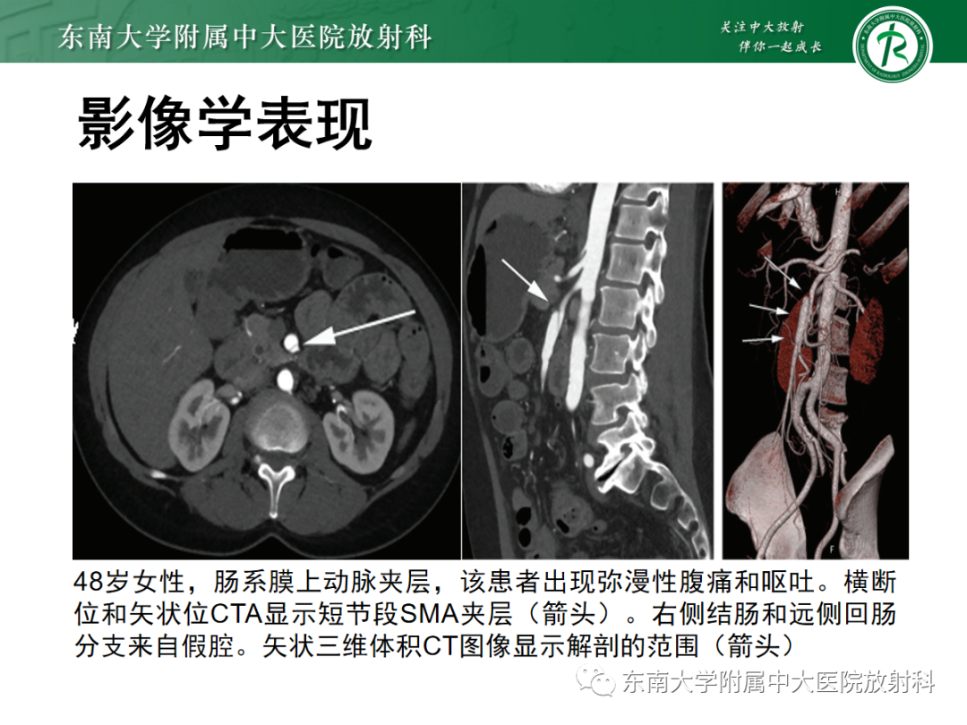 影像PPT - 【PPT】肠系膜上动脉夹层-11