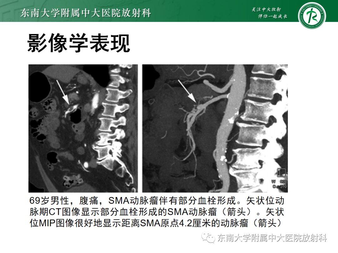影像PPT - 【PPT】肠系膜上动脉夹层-14