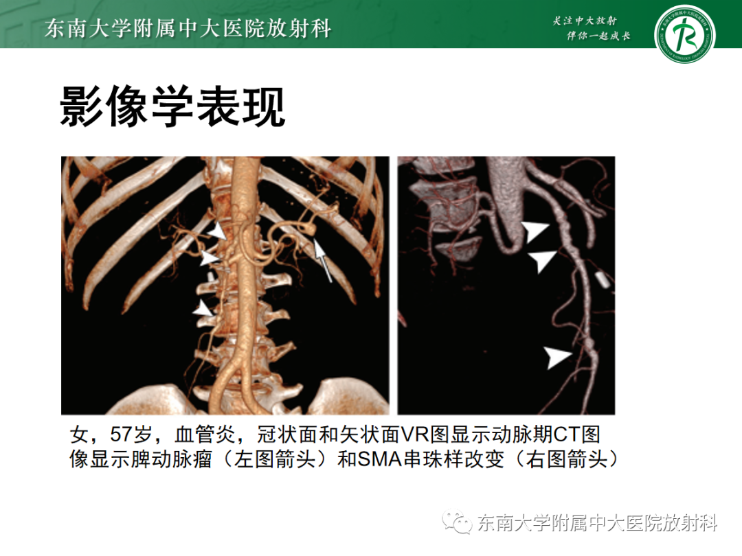 影像PPT - 【PPT】肠系膜上动脉夹层-16