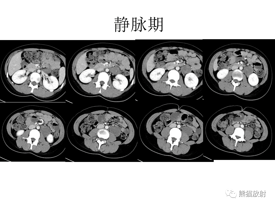 影像PPT - 【病例】节细胞神经瘤 VS 节细胞神经母细胞瘤-5