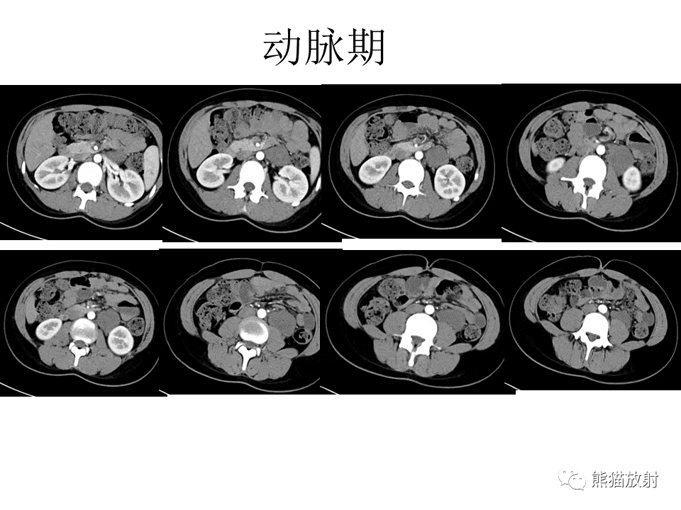 影像PPT - 【病例】节细胞神经瘤 VS 节细胞神经母细胞瘤-4