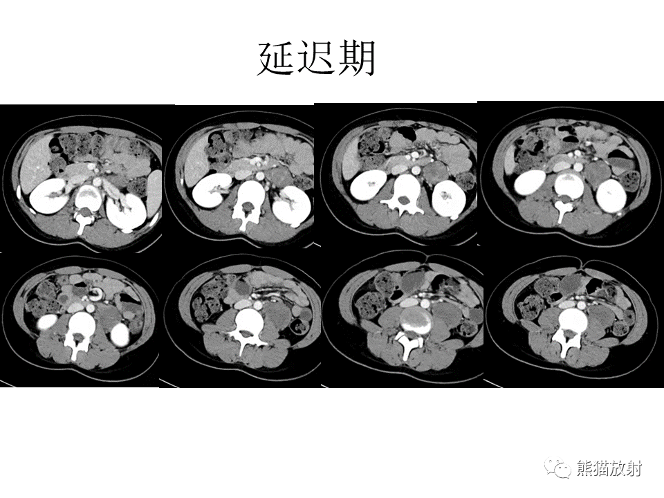 影像PPT - 【病例】节细胞神经瘤 VS 节细胞神经母细胞瘤-6