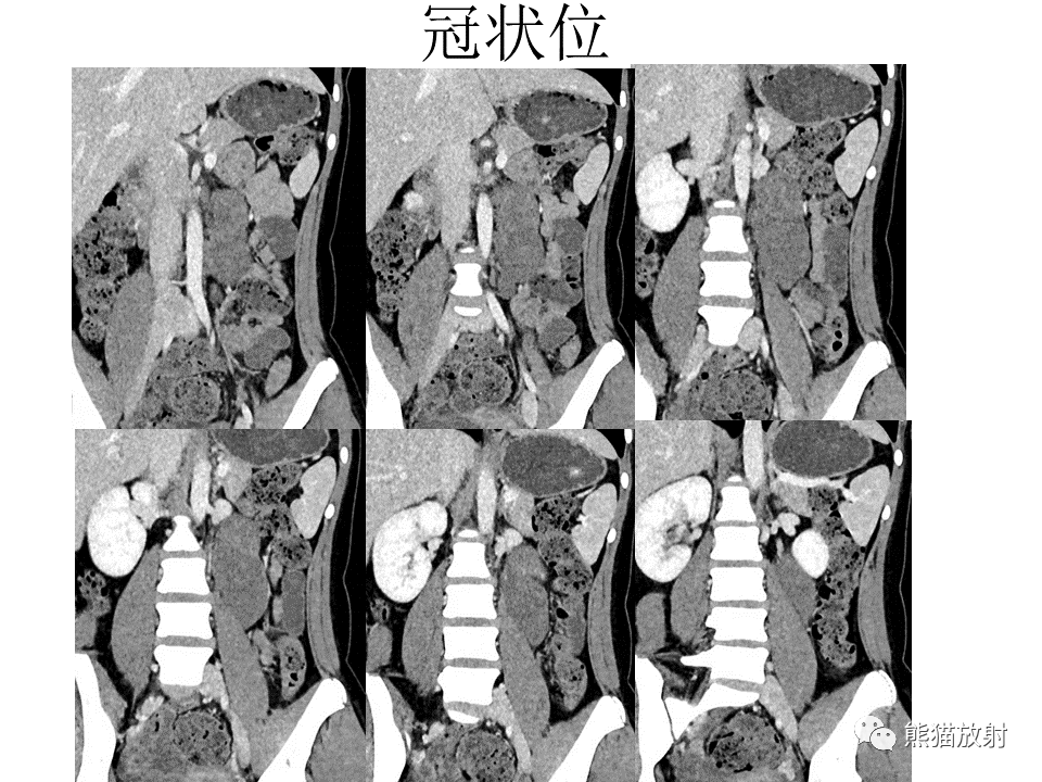 影像PPT - 【病例】节细胞神经瘤 VS 节细胞神经母细胞瘤-7