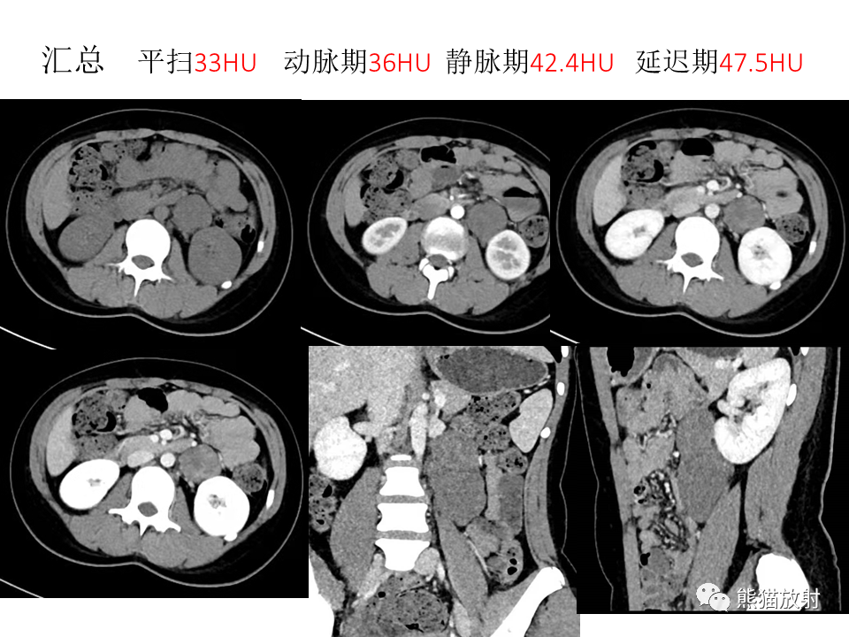 影像PPT - 【病例】节细胞神经瘤 VS 节细胞神经母细胞瘤-9