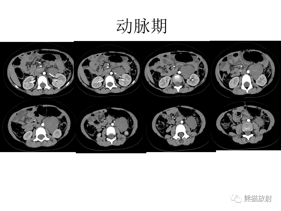 影像PPT - 【病例】节细胞神经瘤 VS 节细胞神经母细胞瘤-13