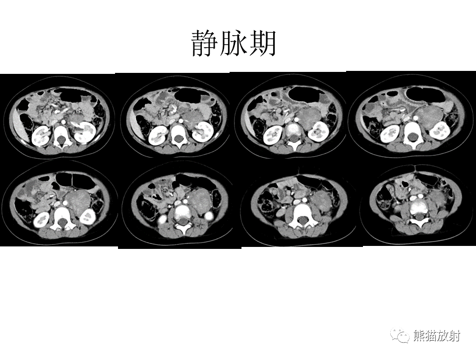 影像PPT - 【病例】节细胞神经瘤 VS 节细胞神经母细胞瘤-14