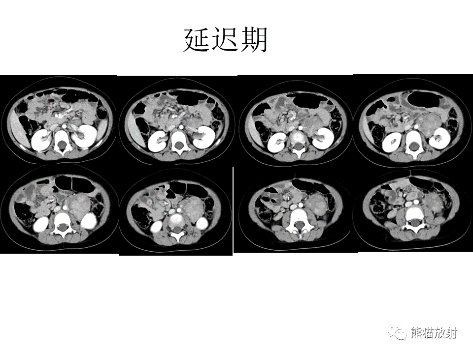 影像PPT - 【病例】节细胞神经瘤 VS 节细胞神经母细胞瘤-15