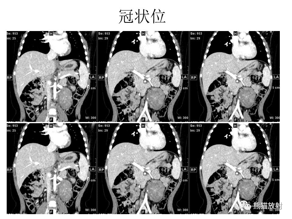 影像PPT - 【病例】节细胞神经瘤 VS 节细胞神经母细胞瘤-16