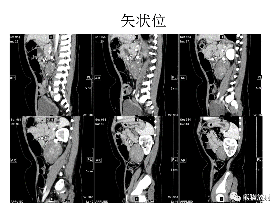 影像PPT - 【病例】节细胞神经瘤 VS 节细胞神经母细胞瘤-17