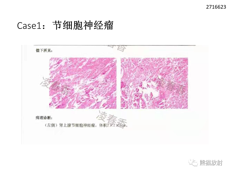 影像PPT - 【病例】节细胞神经瘤 VS 节细胞神经母细胞瘤-20