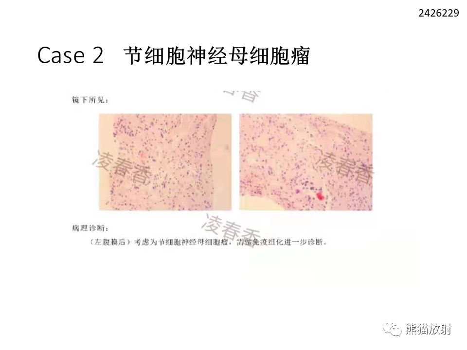 影像PPT - 【病例】节细胞神经瘤 VS 节细胞神经母细胞瘤-21