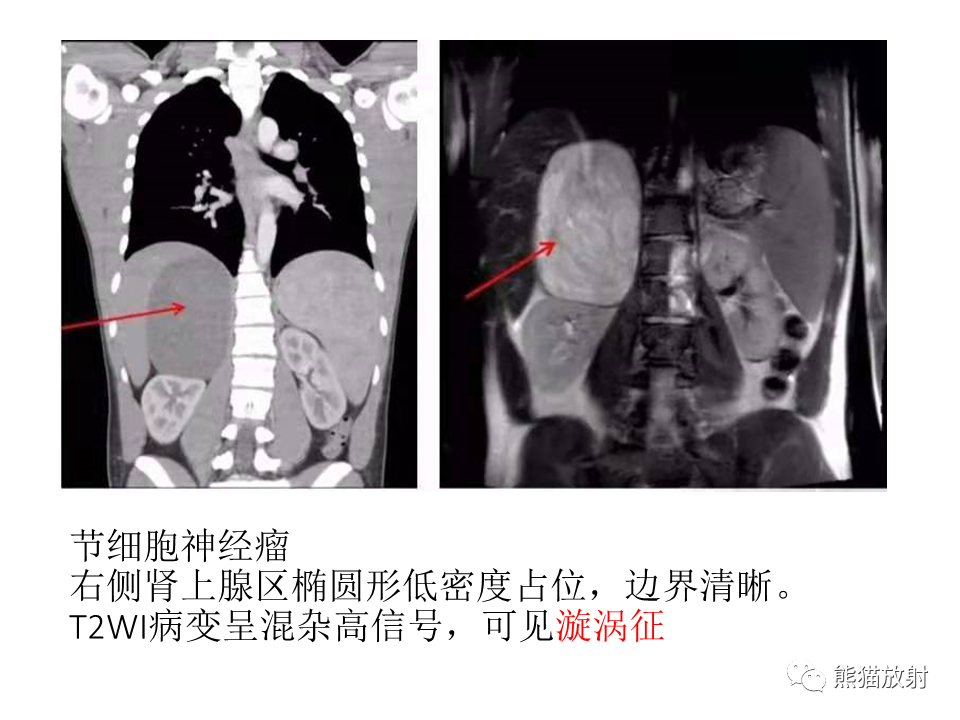 影像PPT - 【病例】节细胞神经瘤 VS 节细胞神经母细胞瘤-29