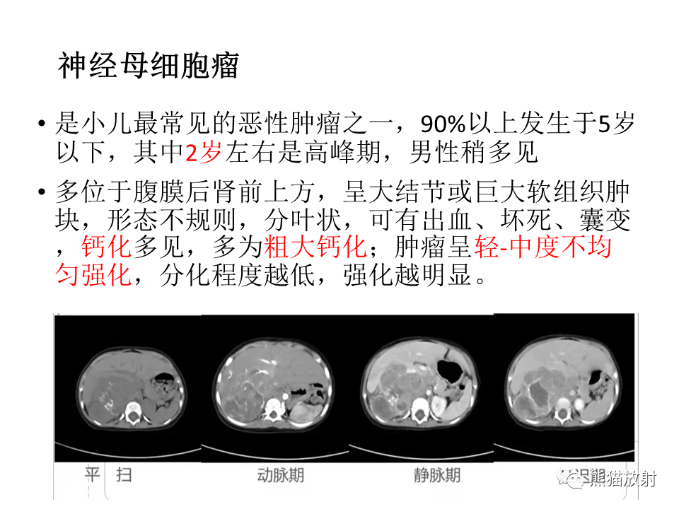 影像PPT - 【病例】节细胞神经瘤 VS 节细胞神经母细胞瘤-33