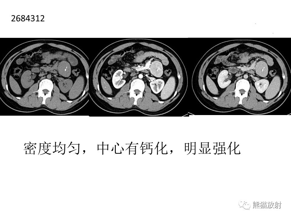 影像PPT - 【病例】节细胞神经瘤 VS 节细胞神经母细胞瘤-41