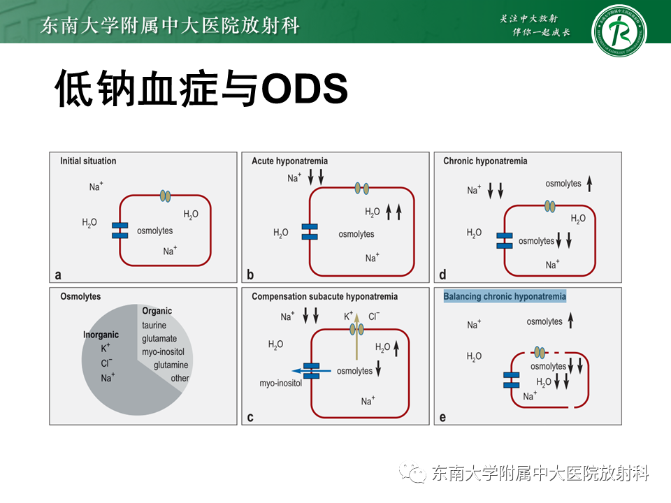 影像PPT - 【PPT】渗透性脱髓鞘综合征-6 影像PPT - 【PPT】渗透性脱髓鞘综合征-6