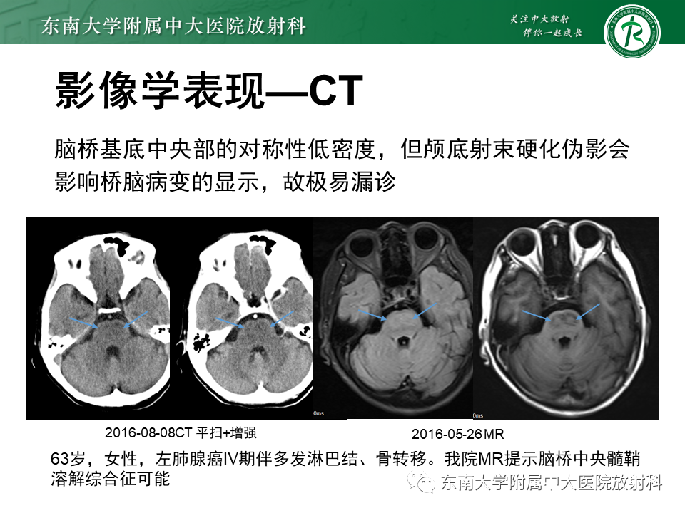 影像PPT - 【PPT】渗透性脱髓鞘综合征-10 影像PPT - 【PPT】渗透性脱髓鞘综合征-10