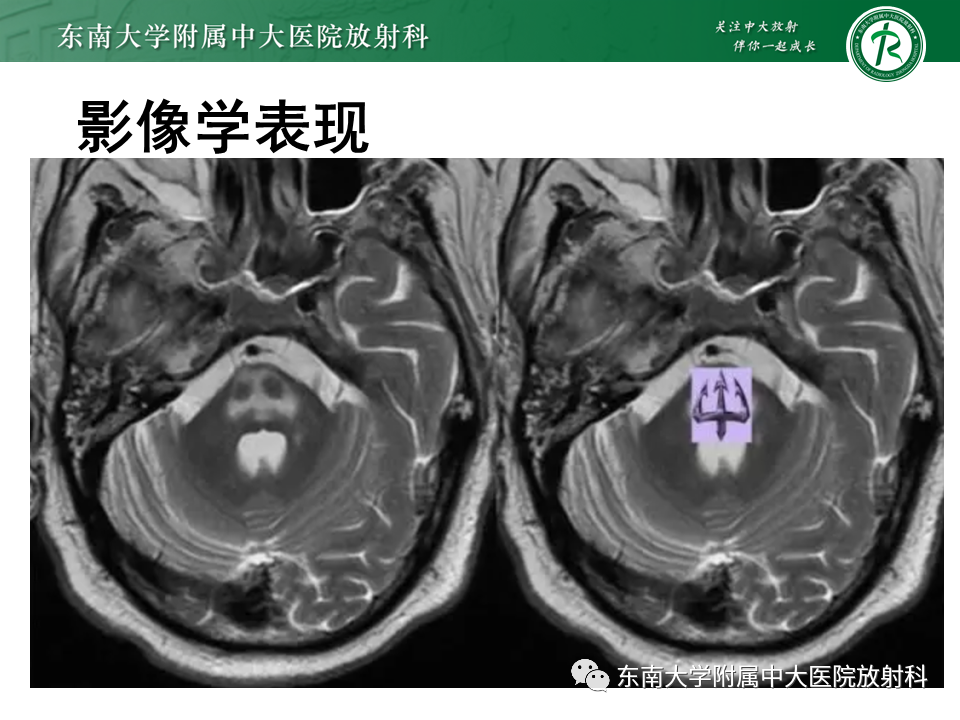影像PPT - 【PPT】渗透性脱髓鞘综合征-12 影像PPT - 【PPT】渗透性脱髓鞘综合征-12