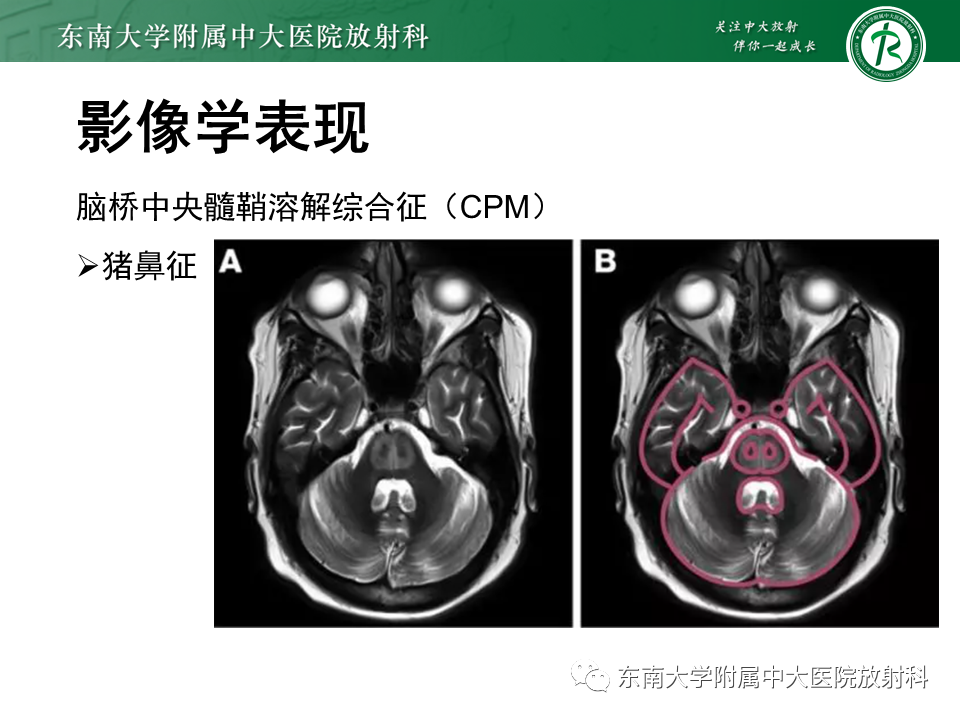 影像PPT - 【PPT】渗透性脱髓鞘综合征-13 影像PPT - 【PPT】渗透性脱髓鞘综合征-13